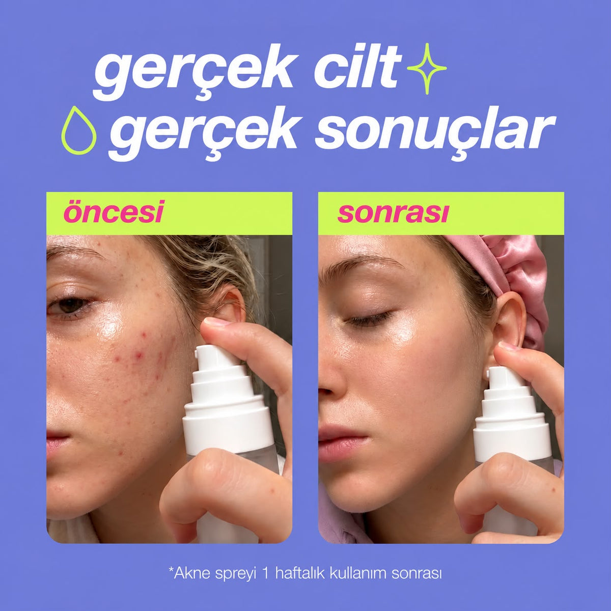 KoreSecret™ Akne-Sivilce Spreyi